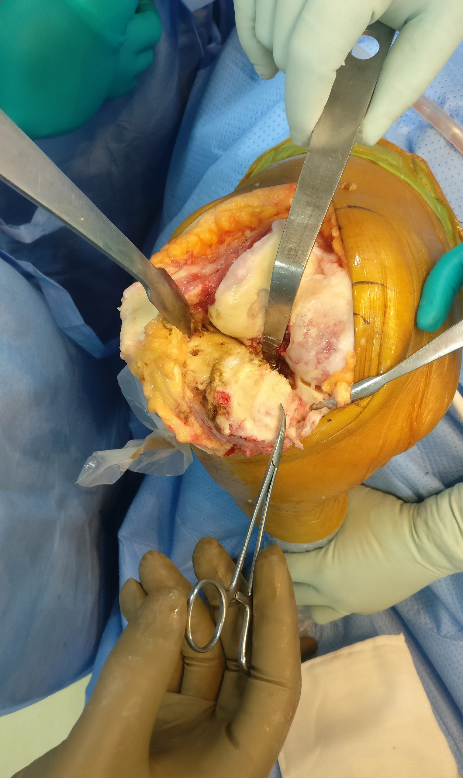 A knee replacement surgery