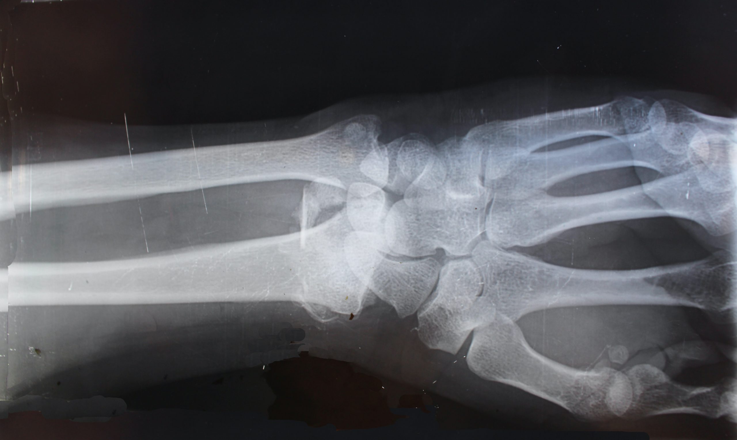 X-ray human wrist bone